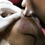 hair transplant UK