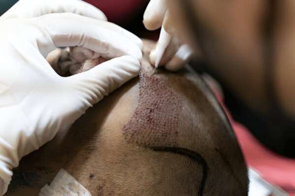 How Hair Transplants Can Help with Thinning Hair hair transplant UK