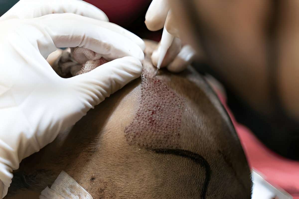 hair transplant UK
