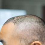 hair transplant