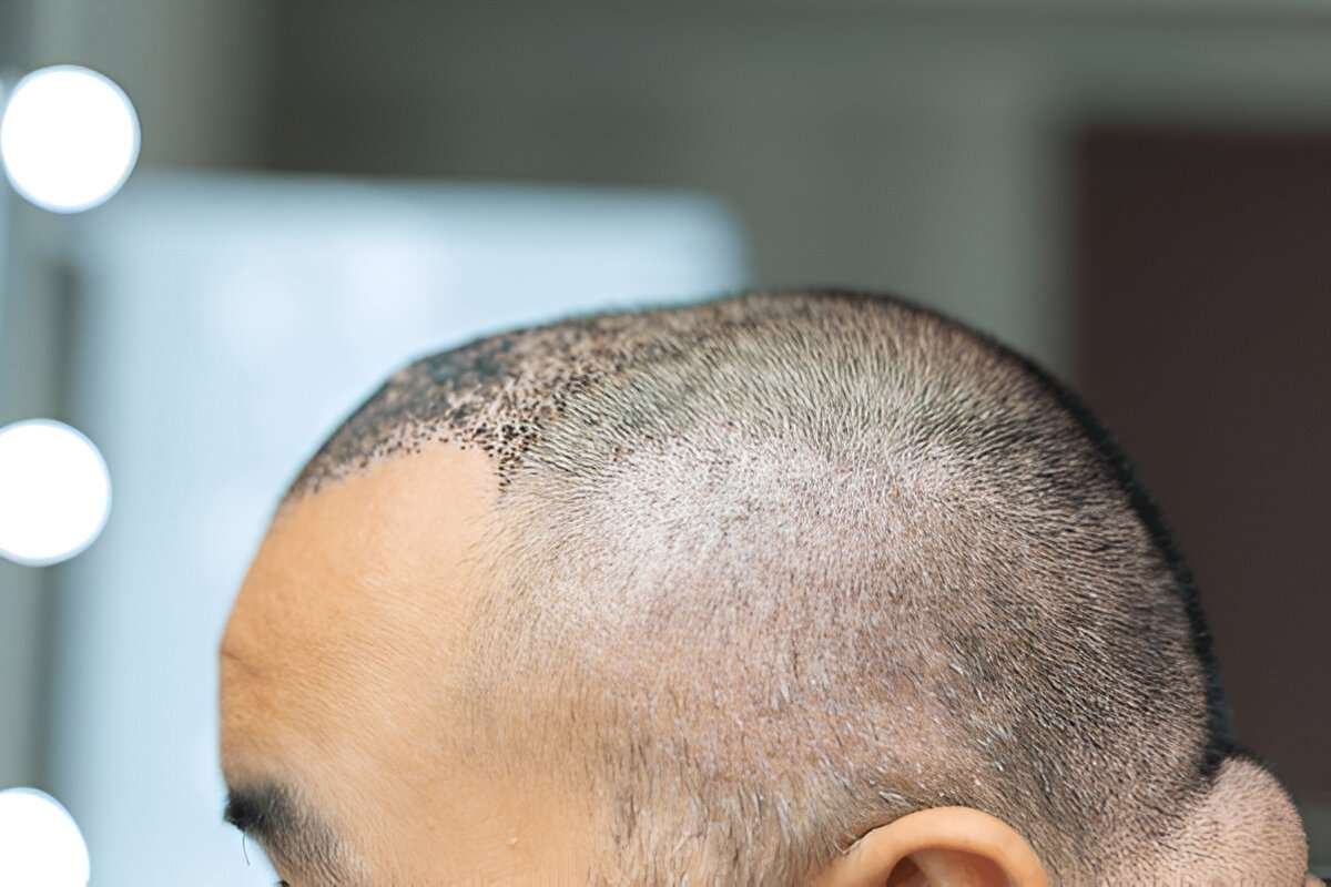 hair transplant
