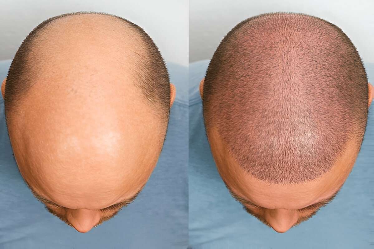 best hair transplant UK
