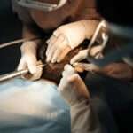 Hair transplant London