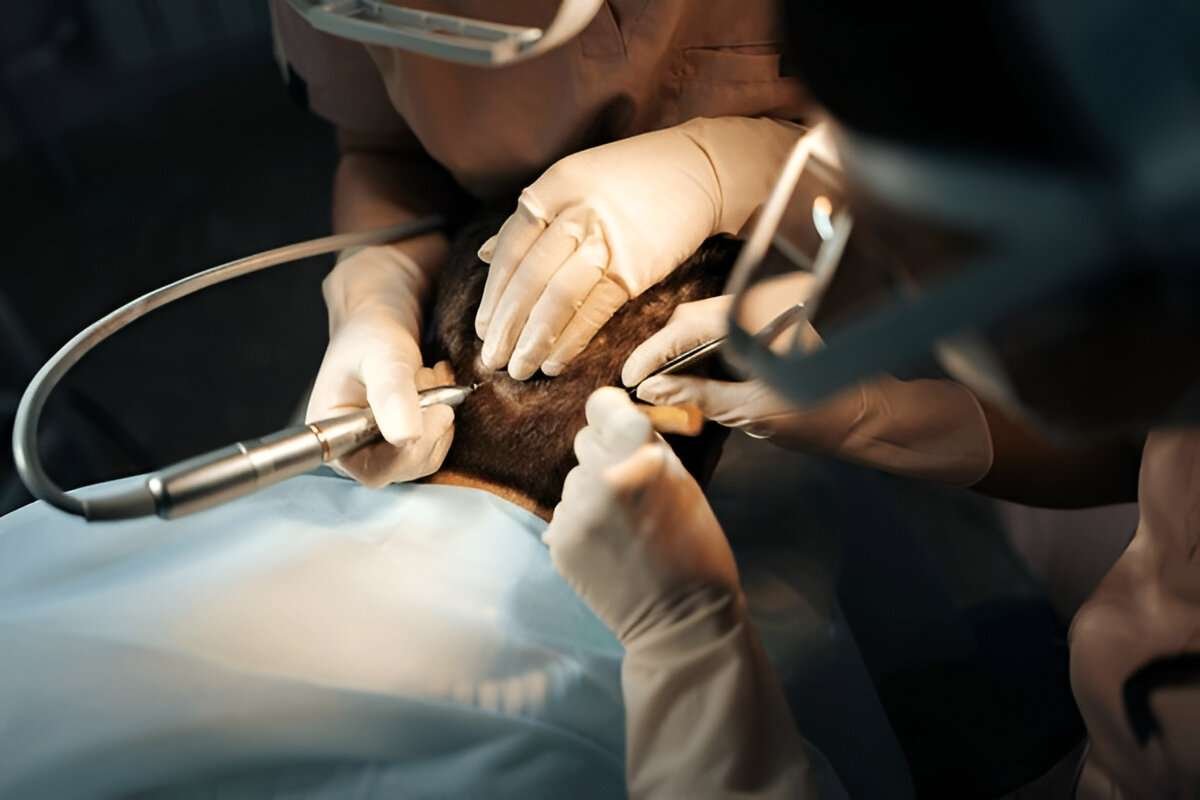 Hair transplant London