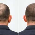Hair Transplant