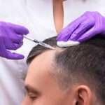 Hair Transplant