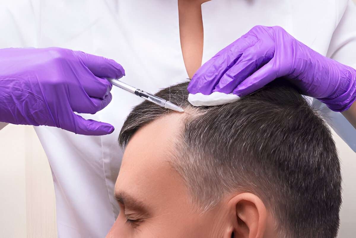 Hair Transplant
