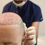 London hair transplant