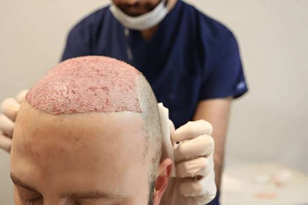 What Are the Best Hair Transplant Options for Men? London hair transplant