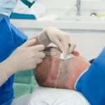 hair Transplant London