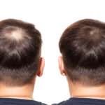 hair transplant Manchester