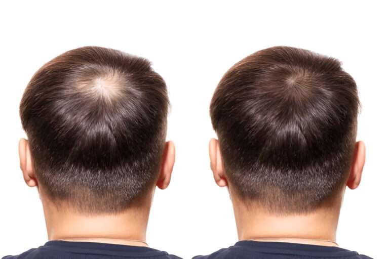 hair transplant Manchester