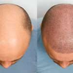 hair transplant UK