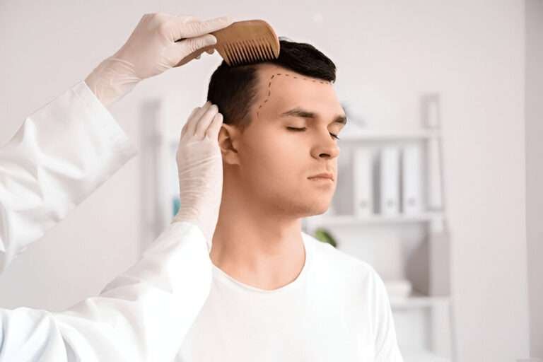 hair transplant Bristol