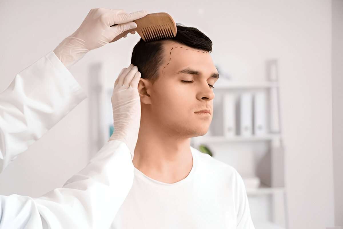 hair transplant Bristol