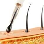 Hair Transplant