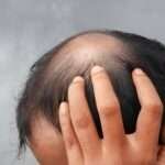 hair transplant