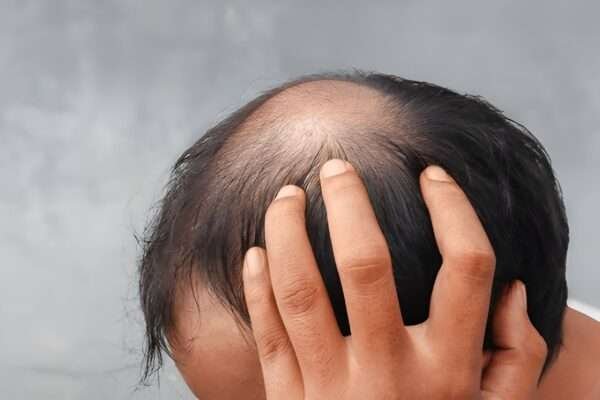How to Avoid the Most Common Hair Transplant Mistakes hair transplant