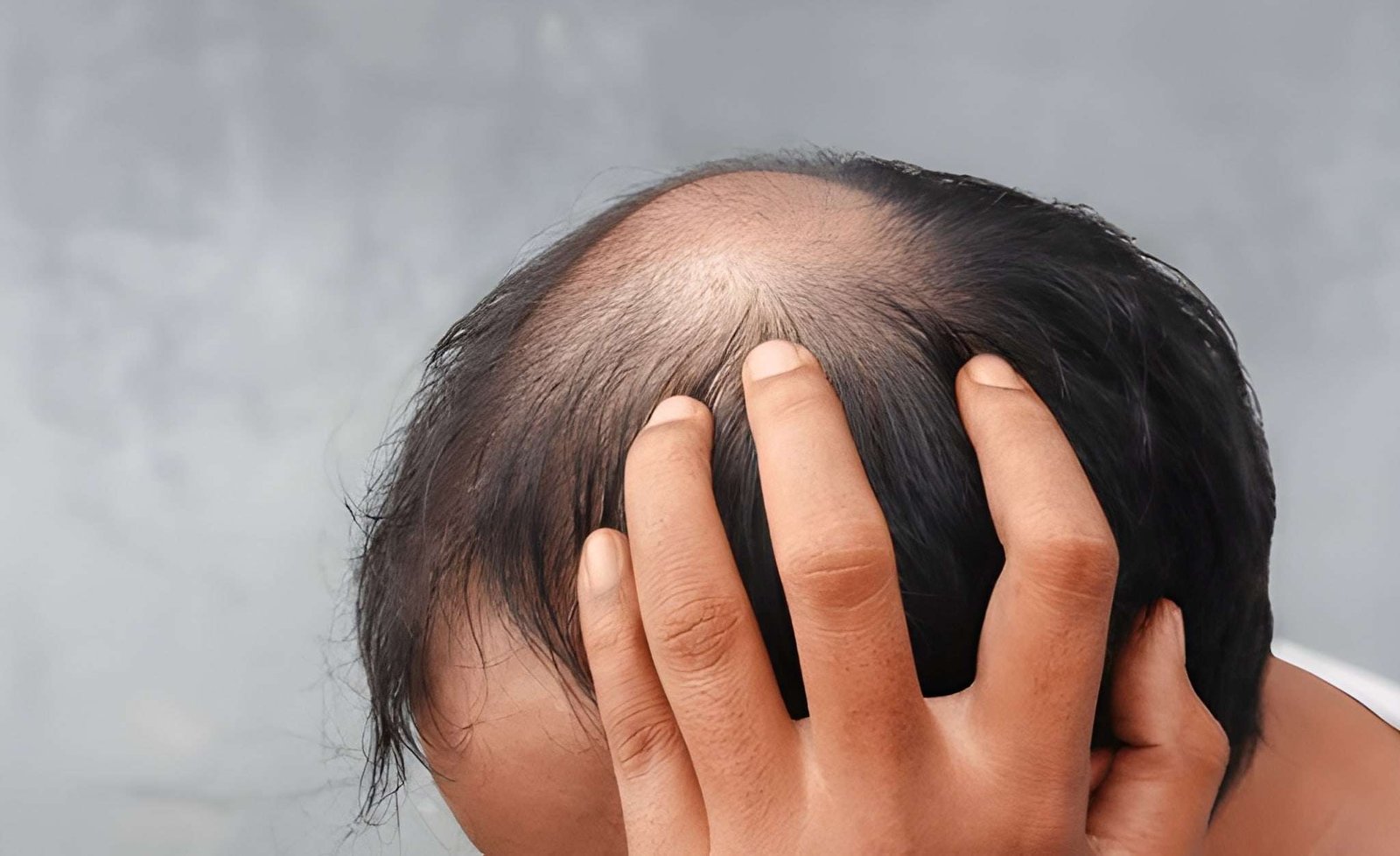 hair transplant