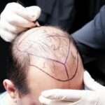 hair transplant London
