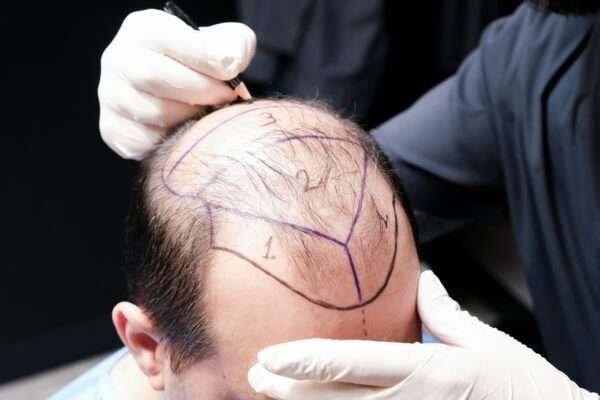 hair transplant London