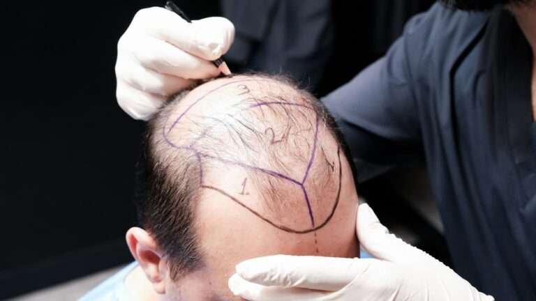 hair transplant London