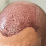 seborrhoeic Dermatitis
