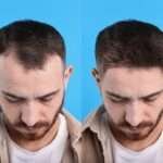 finasteride vs minoxidil