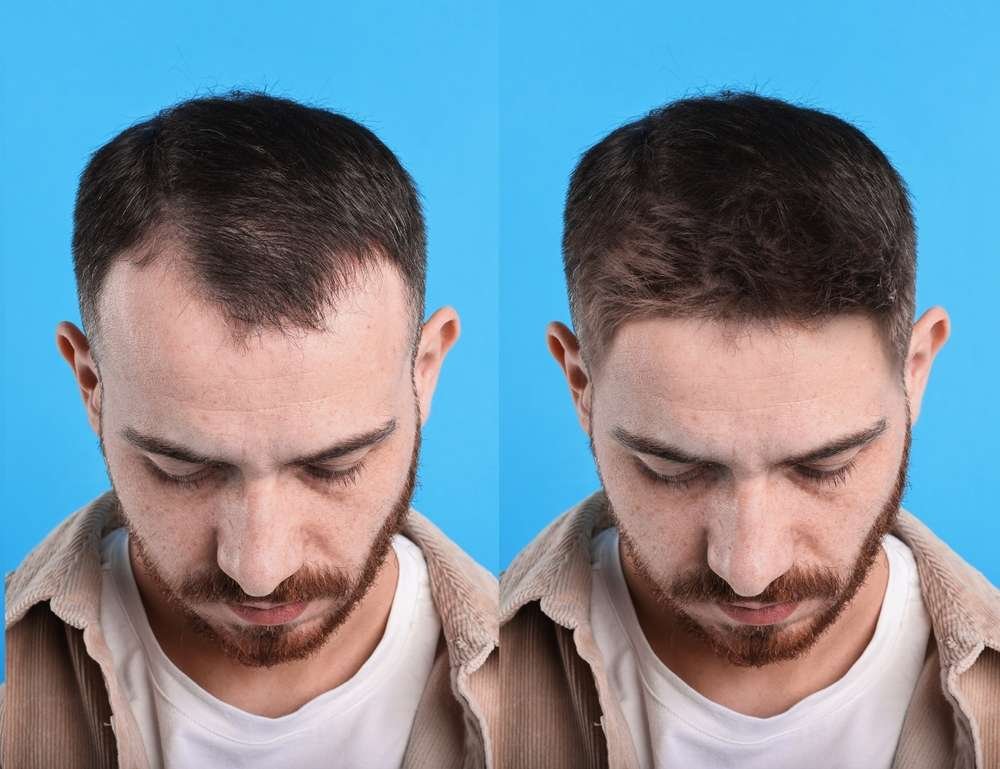 finasteride vs minoxidil