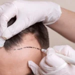 best age for hair transplant