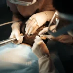 hairloss treatment