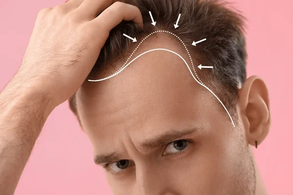 hairloss treatment