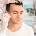 Jude Law hair transplant