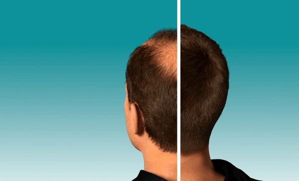 Gordon Ramsay hair transplant before and after