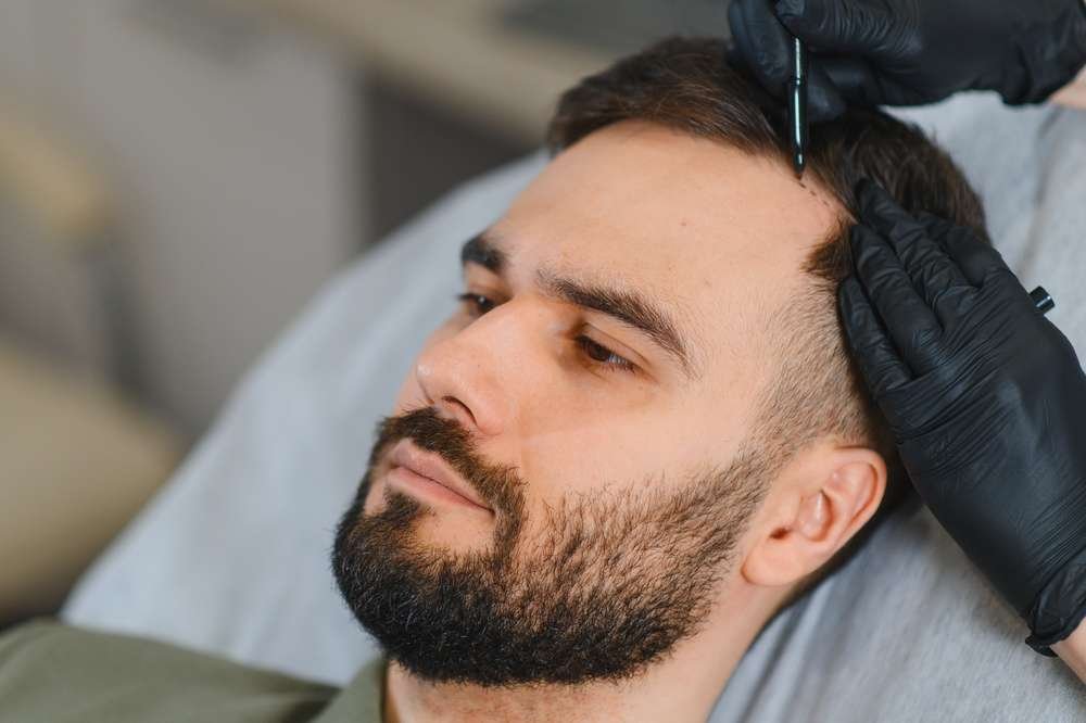 receding hairline