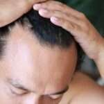 scalp Pigmentation