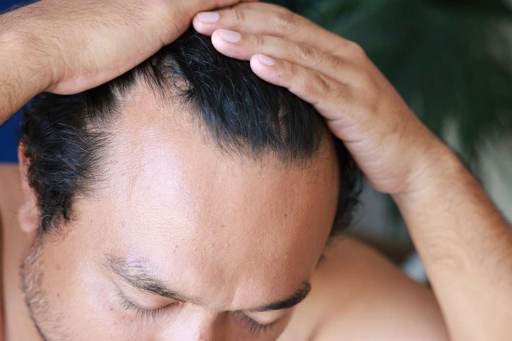 scalp Pigmentation