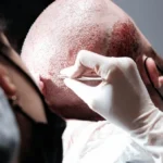 justin bieber hair transplant before and after
