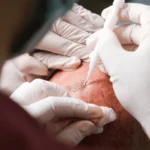 oral minoxidil UK