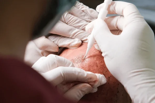 oral minoxidil UK