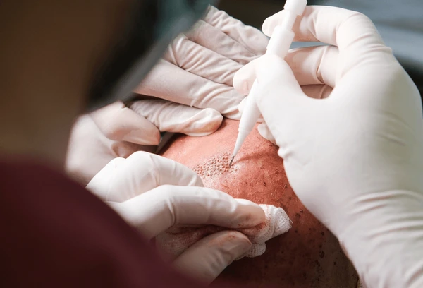 oral minoxidil UK