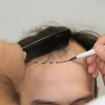 finasteride results