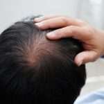 receding hairline