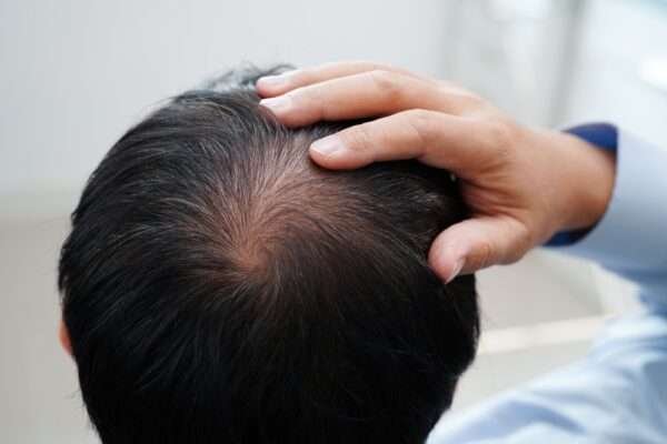 receding hairline